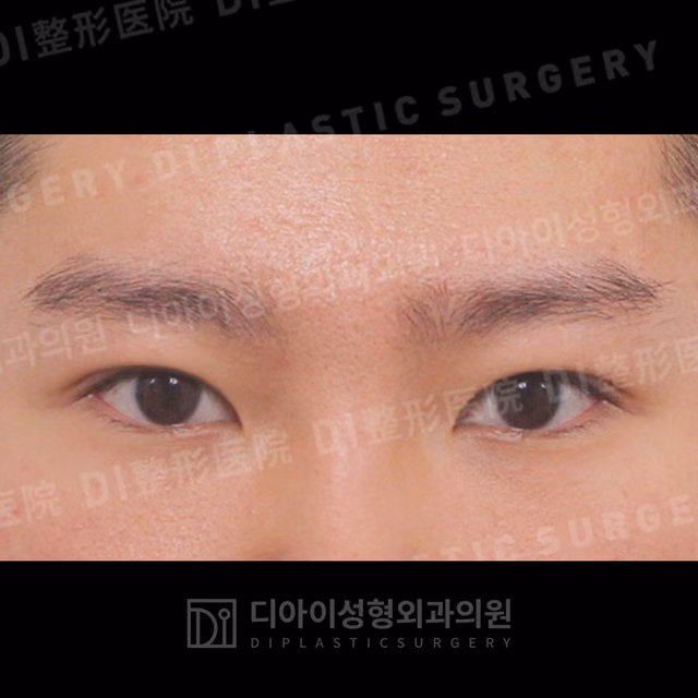 After: Incisional double-eyelid surgery · Ptosis correction, Front