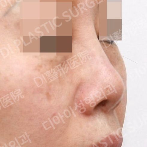Before surgery: case 529, Short-nose correction