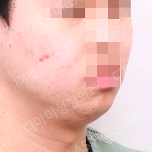 Before surgery: case 130, Chin implant