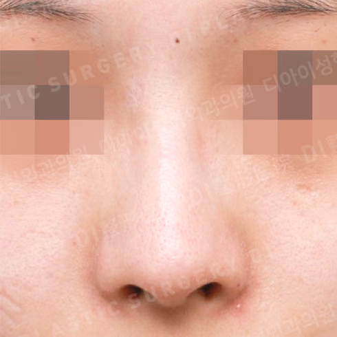 Before surgery: case 678, Long-nose correction