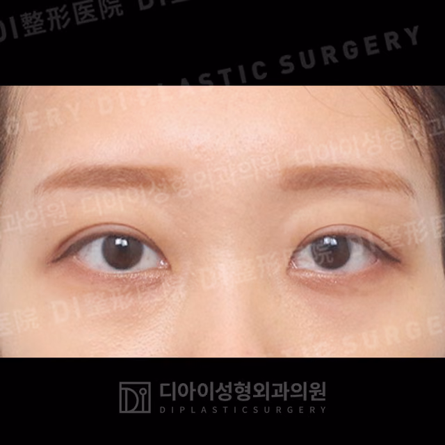After: Incisional double-eyelid surgery · Ptosis correction · Upper-eyelid fat repositioning, Front