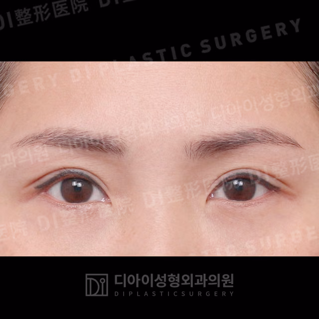 After: Incisional double-eyelid surgery · Upper canthoplasty, Front