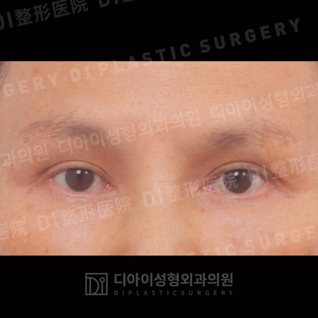After: Incisional eyelid revision, Front