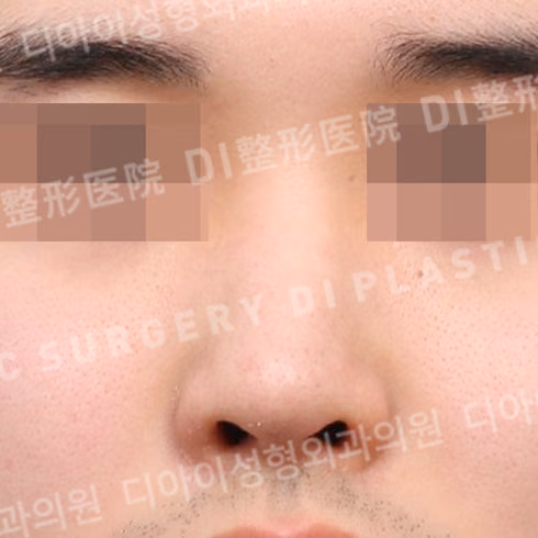 Before surgery: case 719, Rhinoplasty with own rib cartilage