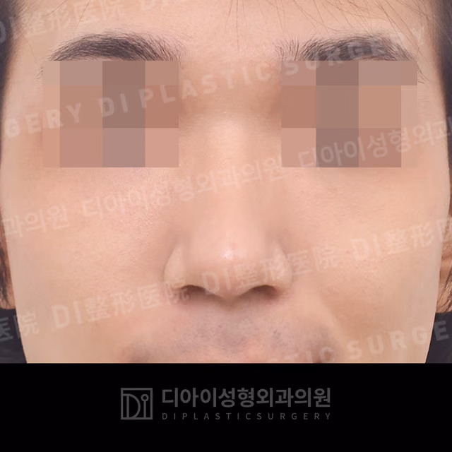 After: Dorsal hump correction · Bulbous-nose correction · Rhinoplasty without implants, Front
