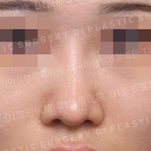 After surgery: case 659, Low-bridge rhinoplasty · Bulbous-nose correction, 1 month after surgery
