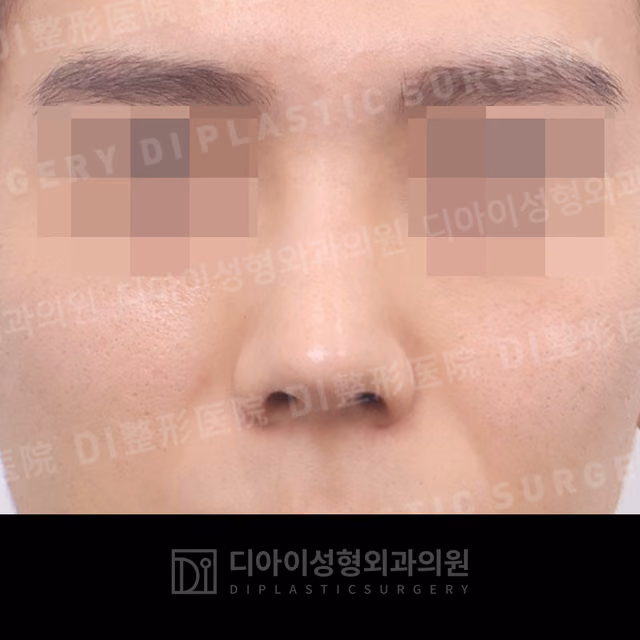 After: Dorsal hump correction · Osteotomy · Deviated-nose correction, Front