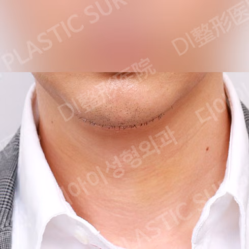 颈部提升 · 埋线提升 · 正面 · 术后