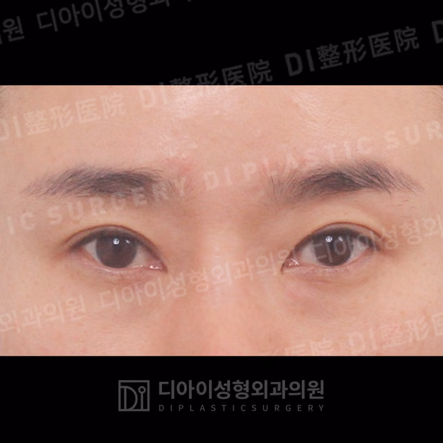 Before: Incisional eyelid revision, Front