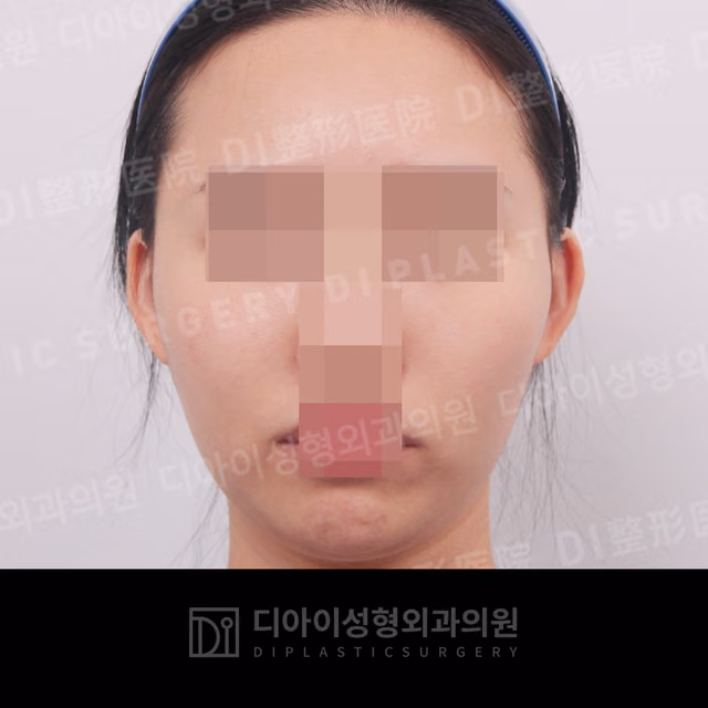 Before surgery: case 014, Cheekbone reduction