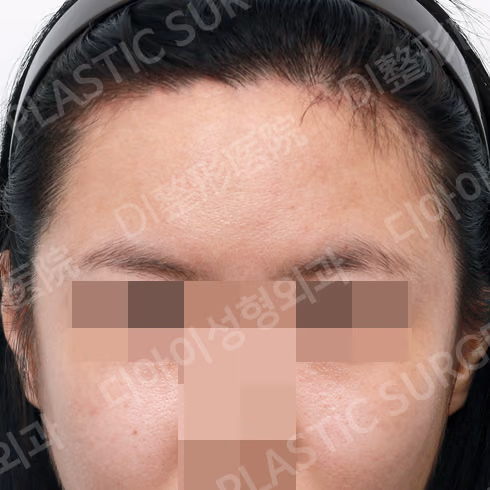 After surgery: case 409, Forehead reduction, 1 month after surgery