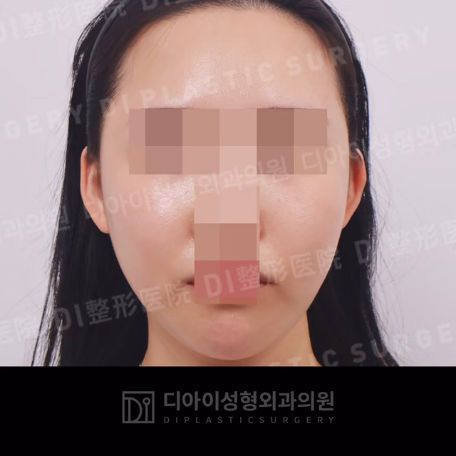 After surgery: case 014, Cheekbone reduction, 6 months after surgery