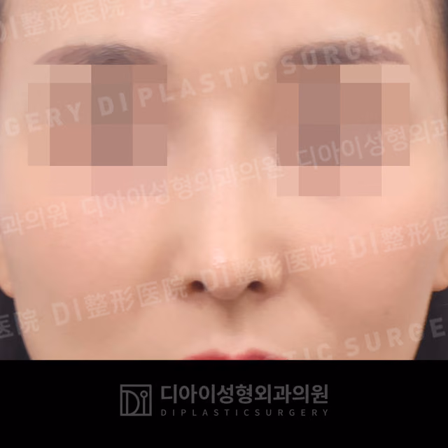 After: Own rib cartilage · Revision rhinoplasty · Dorsal hump correction · Paranasal augmentation, Front