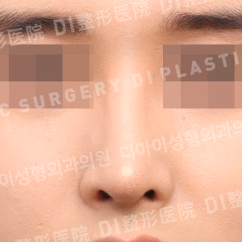 After surgery: case 719, Rhinoplasty with own rib cartilage, 1 month after surgery