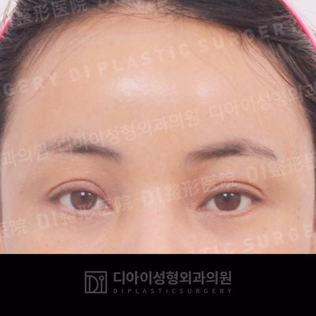 After surgery: case 035, Forehead lift, 10 days after surgery