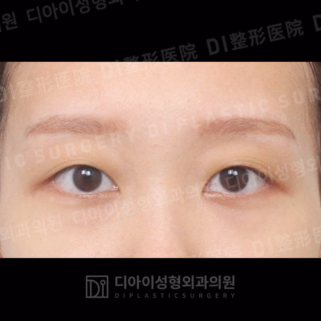 Before: Incisional double-eyelid surgery · Ptosis correction · Upper-eyelid fat repositioning, Front
