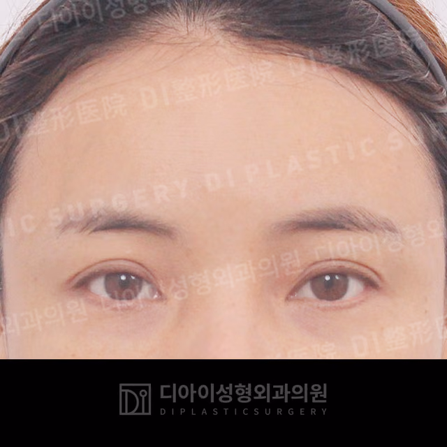 Before surgery: case 035, Forehead lift