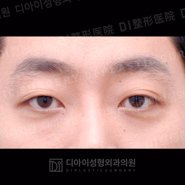 Before surgery: case 277, Incisional double-eyelid surgery