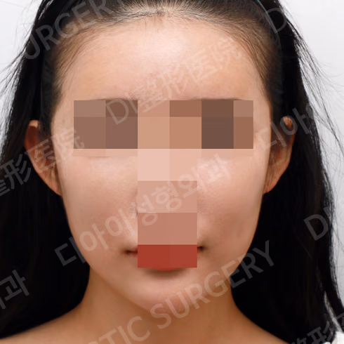 脂肪移植 · 正面 · 术后