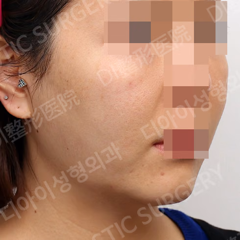Before surgery: case 037, Thread lift