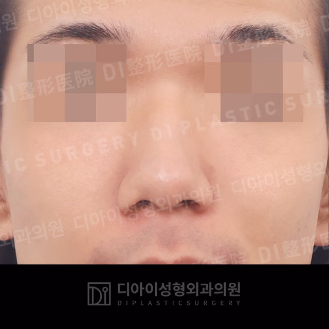 Before: Dorsal hump correction · Bulbous-nose correction · Rhinoplasty without implants, Front