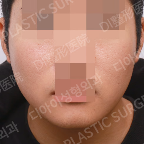 After surgery: case 342, Square-jaw reduction, 1 month after surgery