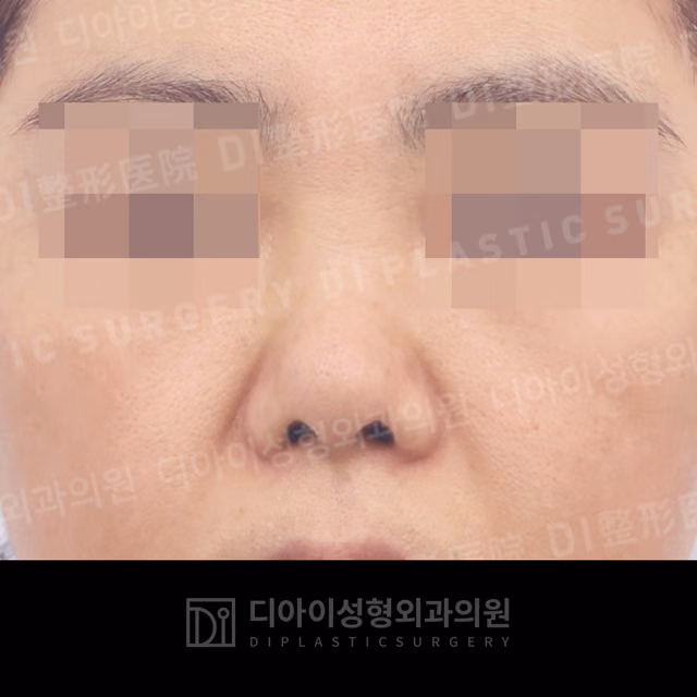 Before: Own rib cartilage · Revision rhinoplasty · Short-nose correction · Paranasal augmentation, Front