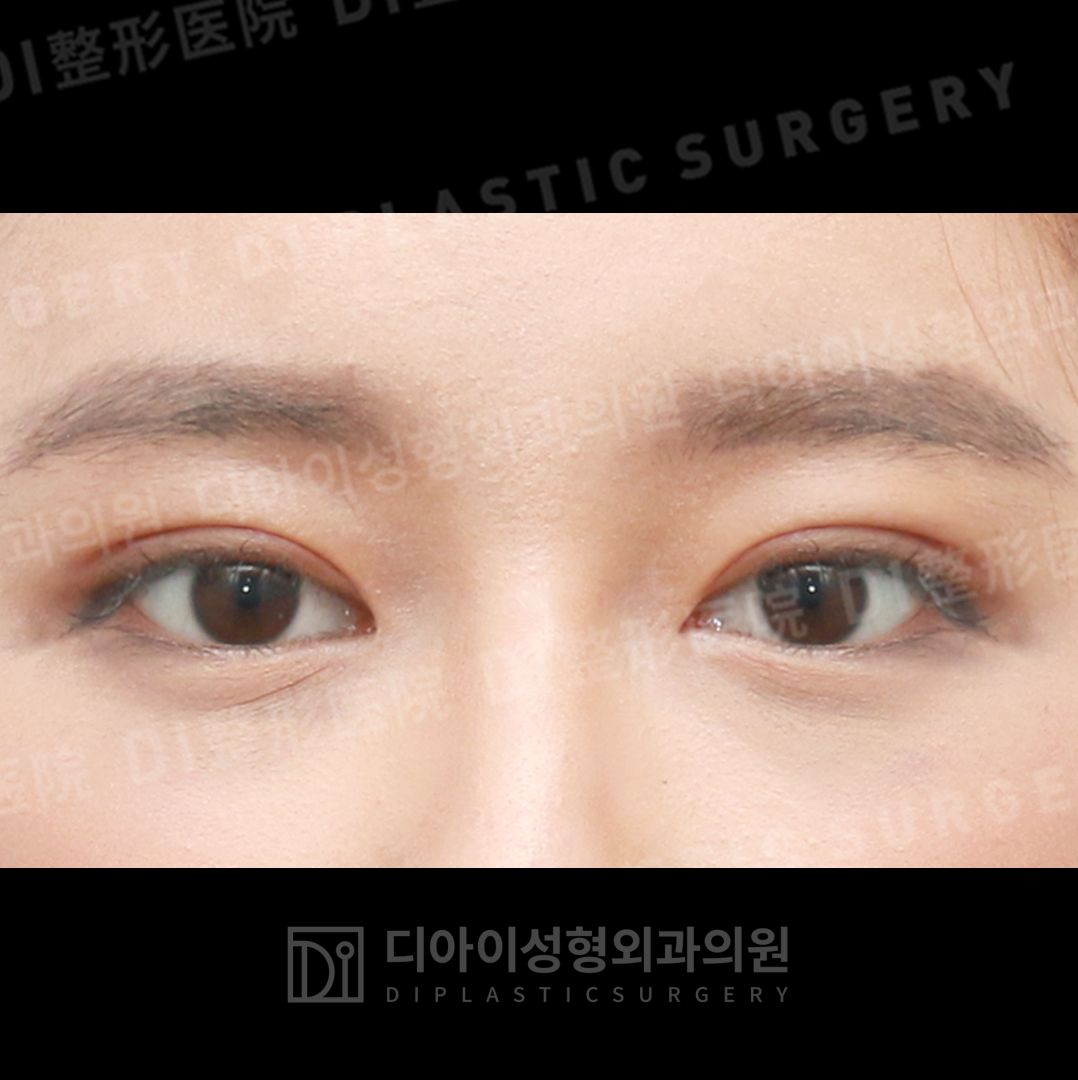 CASE 1 · After