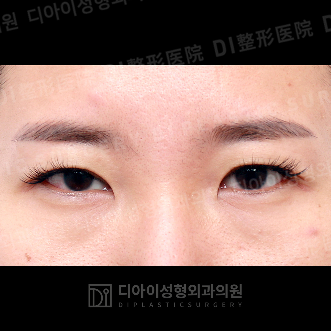 CASE 2 · After