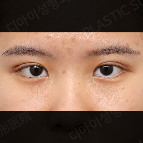 CASE 4 · After
