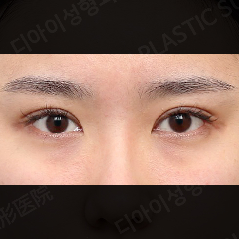 CASE 5 · After