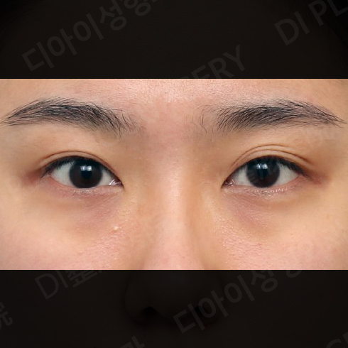 CASE 5 · Before
