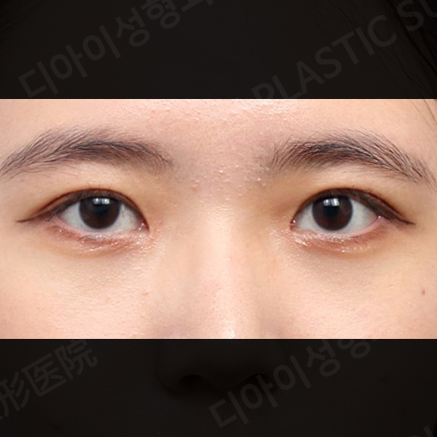CASE 6 · After