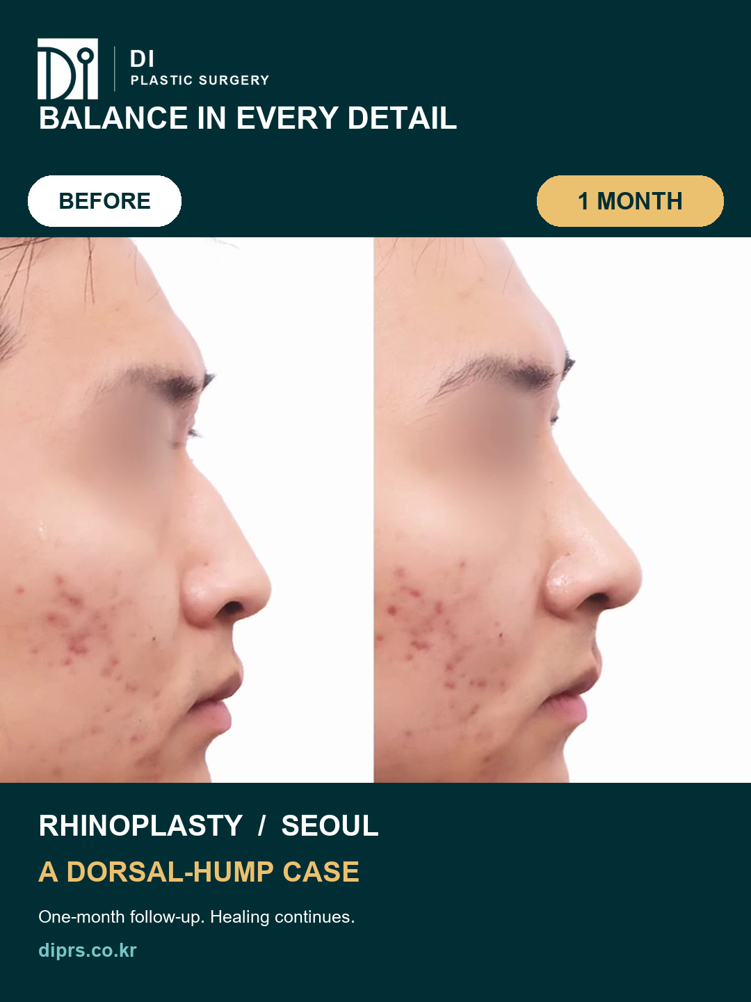 Real DI patient profile comparison before dorsal hump rhinoplasty and at a one-month follow-up