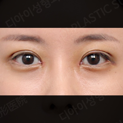 CASE 6 · After