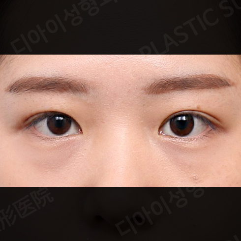 CASE 6 · After