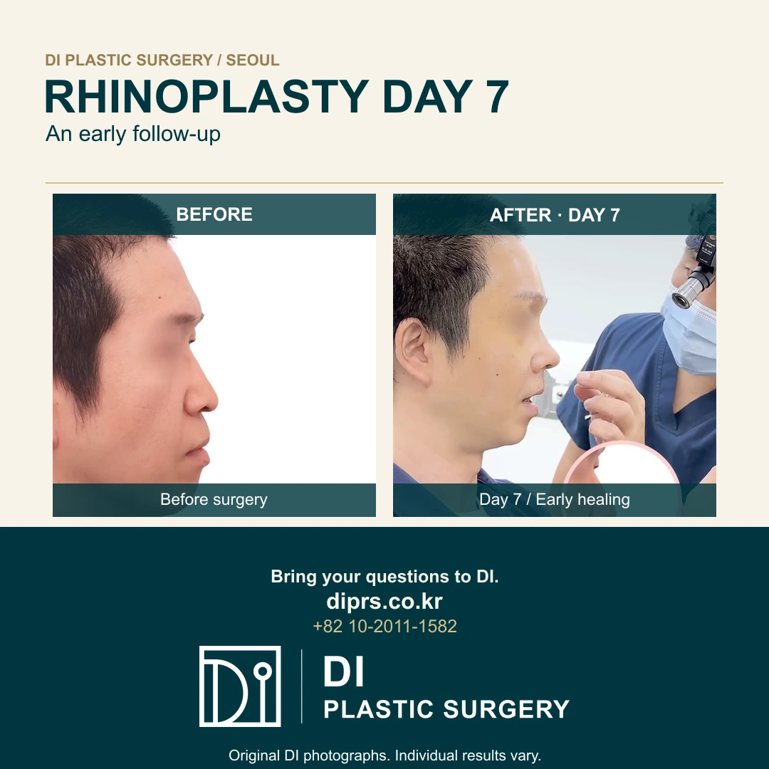 Rhinoplasty: Before Surgery and Day-Seven Follow-Up