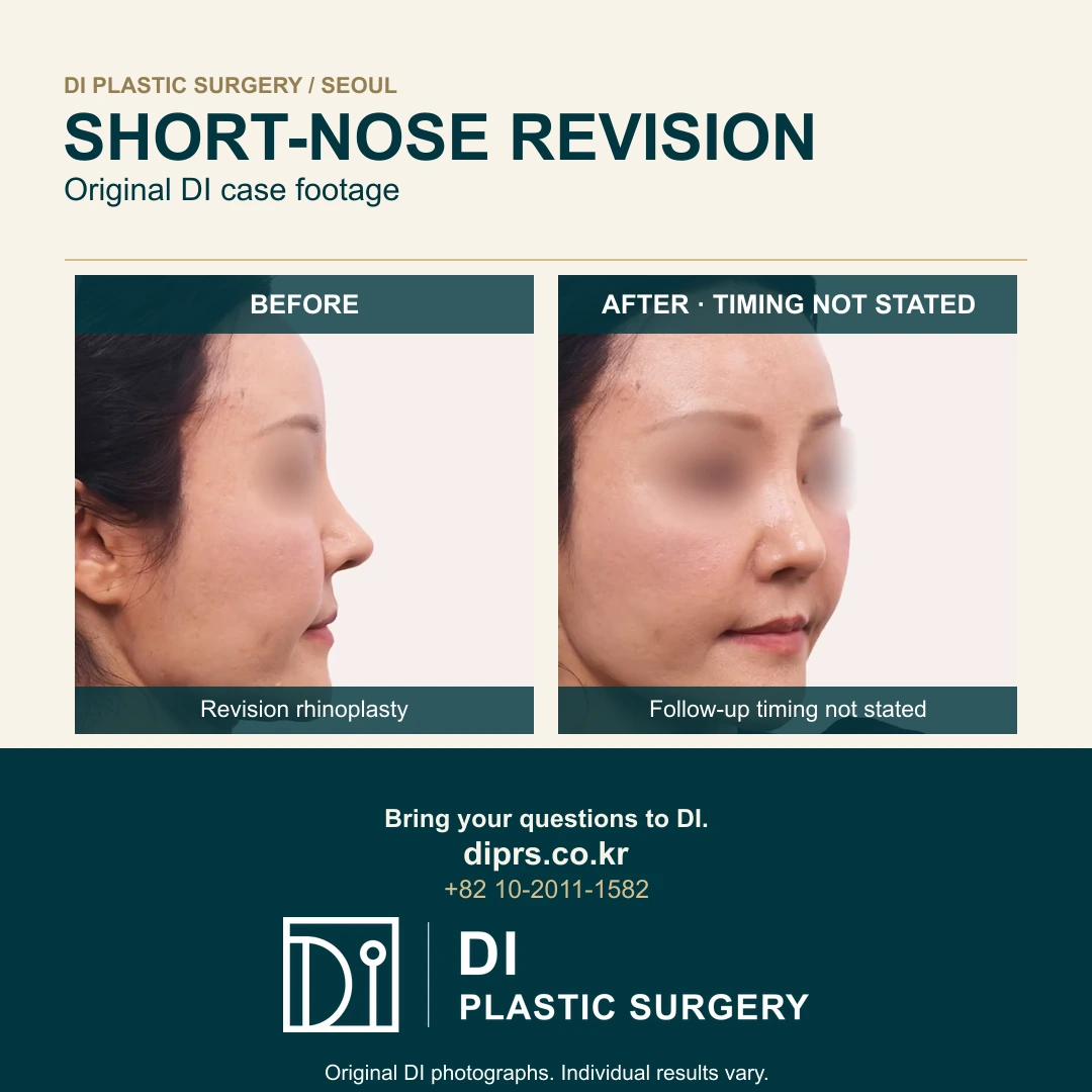 Short-Nose Revision Rhinoplasty: Original DI Case