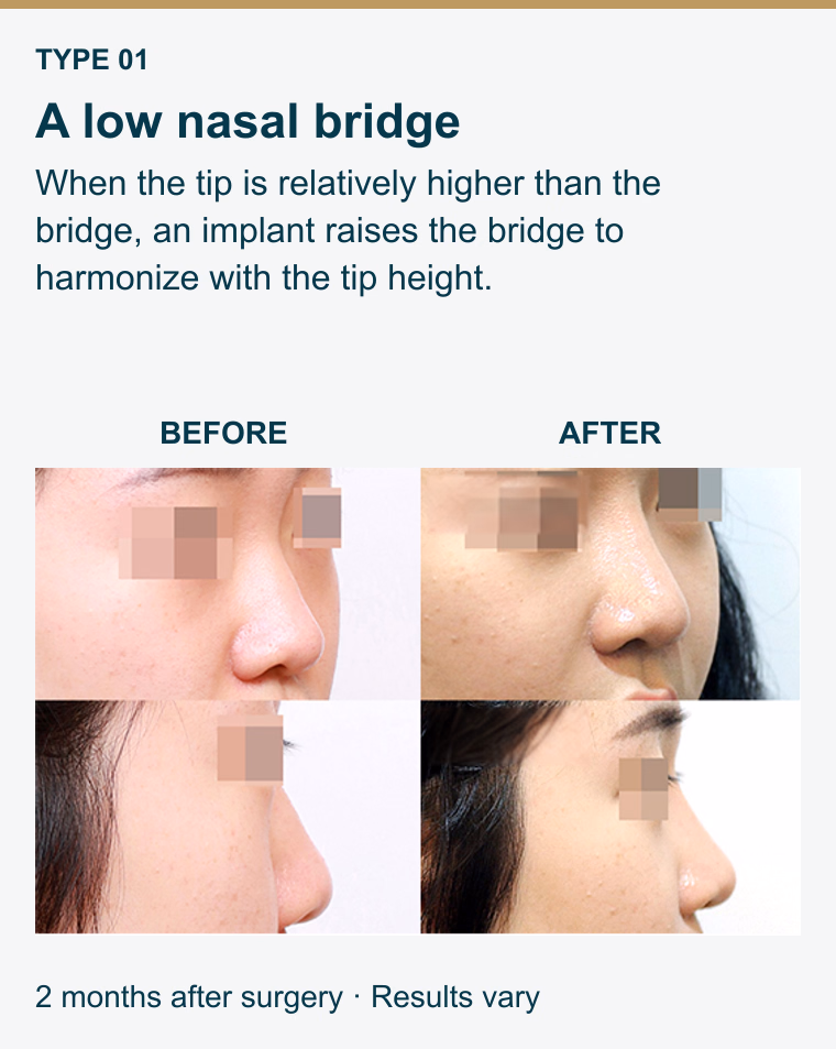 Type 1. A low nasal bridge. When the tip is relatively higher than the bridge, an implant raises the bridge to harmonize with the tip height. Before and after photographs. 2 months after surgery. Results vary.