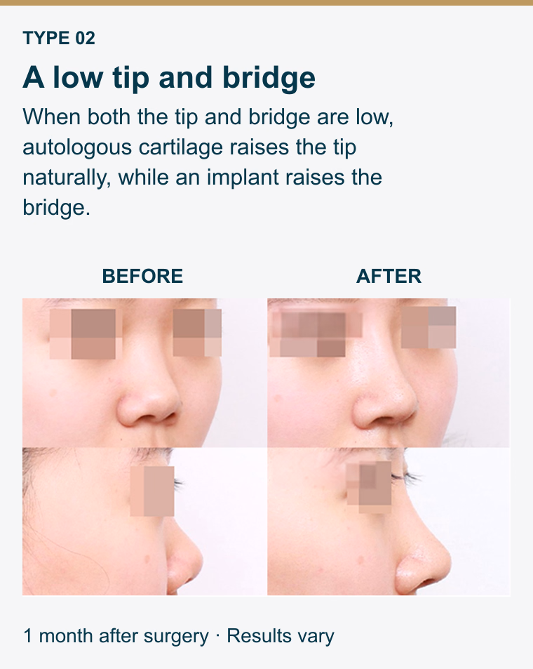 Type 2. A low tip and bridge. When both the tip and bridge are low, autologous cartilage raises the tip naturally, while an implant raises the bridge. Before and after photographs. 1 month after surgery. Results vary.