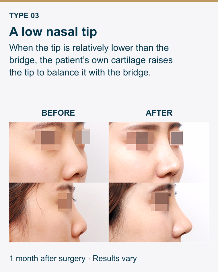 Type 3. A low nasal tip. When the tip is relatively lower than the bridge, the patient’s own cartilage raises the tip to balance it with the bridge. Before and after photographs. 1 month after surgery. Results vary.