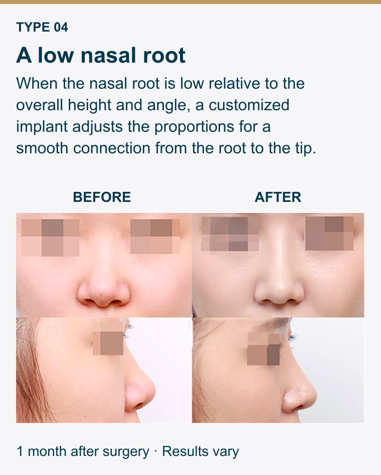 Type 4. A low nasal root. When the nasal root is low relative to the overall height and angle, a customized implant adjusts the proportions for a smooth connection from the root to the tip. Before and after photographs. 1 month after surgery. Results vary.
