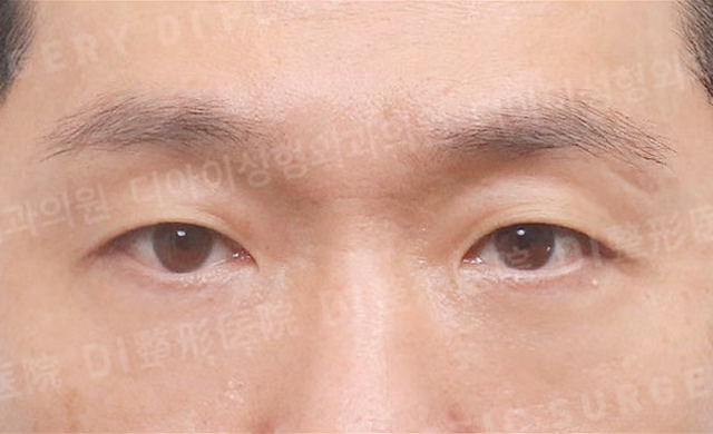 จัดเรียงไขมันใต้ตา · ด้านหน้า · หลังทำ