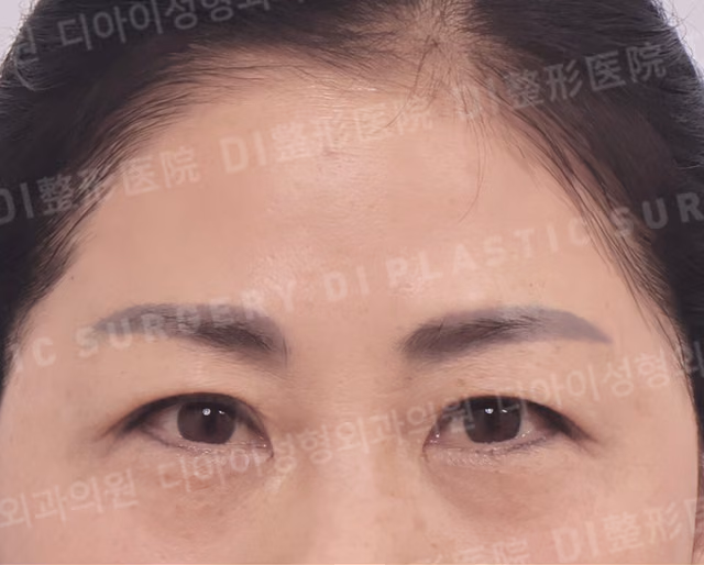 額リフト · 下眼瞼形成術 · 正面 · 術前