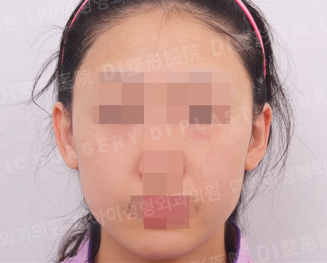 脂肪移植 · 正面 · 术前