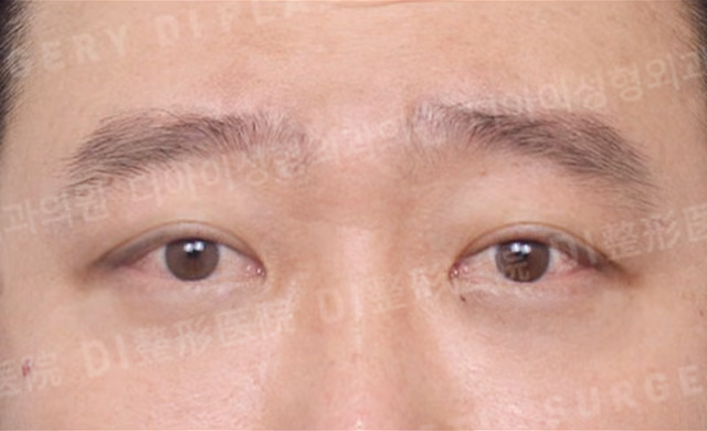 จัดเรียงไขมันใต้ตา · ด้านหน้า · หลังทำ