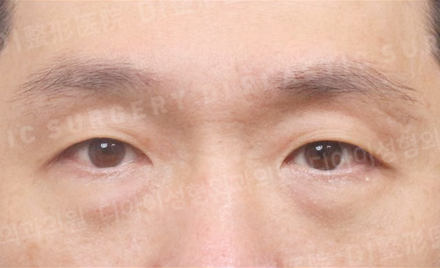 จัดเรียงไขมันใต้ตา · ด้านหน้า · ก่อนทำ