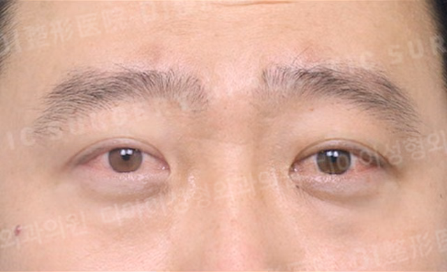 จัดเรียงไขมันใต้ตา · ด้านหน้า · ก่อนทำ