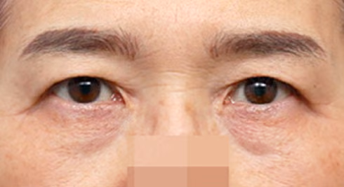 ยกกระชับใต้คิ้ว · ศัลยกรรมเปลือกตาล่าง · ด้านหน้า · ก่อนทำ
