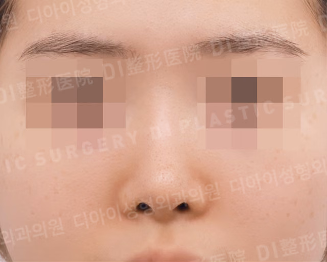 Sụn sườn tự thân · Phẫu thuật sửa mũi · Chỉnh mũi ngắn · Làm đầy nền mũi · Chính diện · Trước